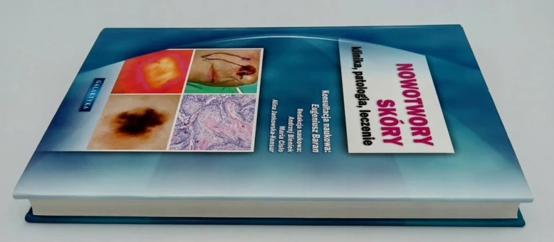 NOWOTWORY SKÓRY KLINIKA PATOLOGIA LECZENIE Eugeniusz Baran