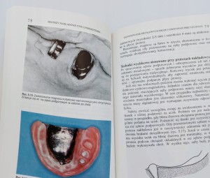 Protezy nakładowe typu Overdentures w ogólnej praktyce stomatologicznej